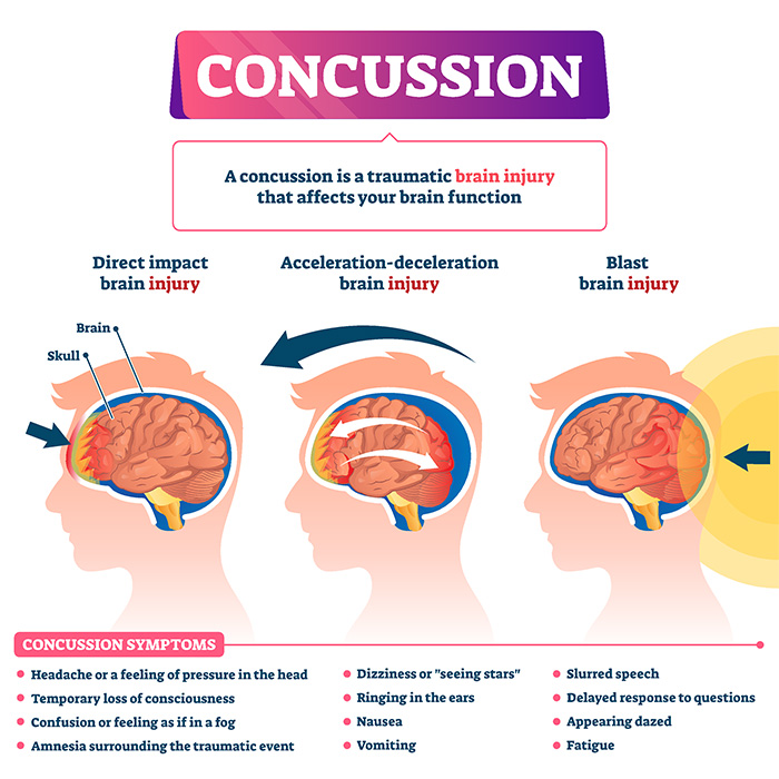 Concussion in afl: subsequent injury and rehabilitation
