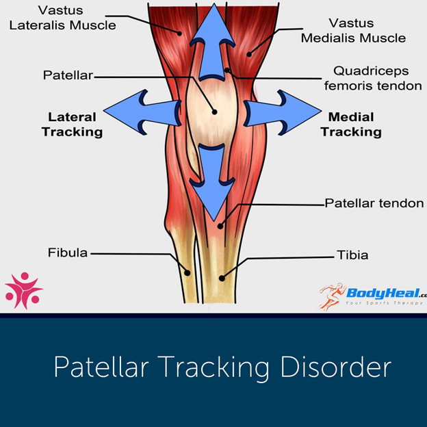 The Best Patellar Tracking Disorder Treatment Modalities!