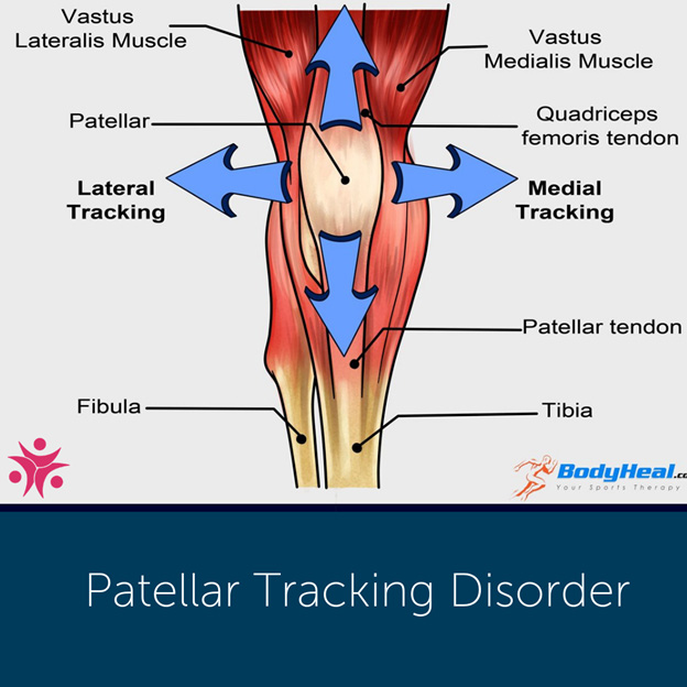 Patellofemoral Tracking Syndrome: What is It?