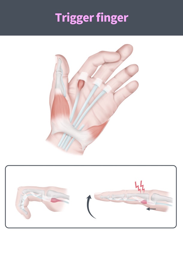 Ulnar tunnel syndrome: Causes, treatment, and exercises