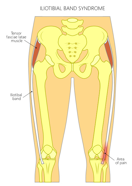 What Causes Lateral Knee Pain?