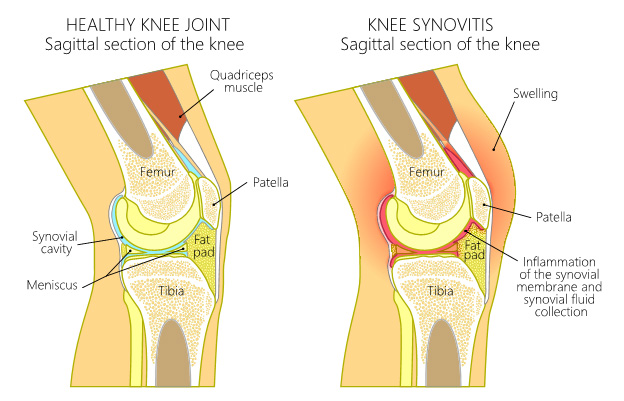 Knee Pain from Driving: Unveiling the Causes and Solutions