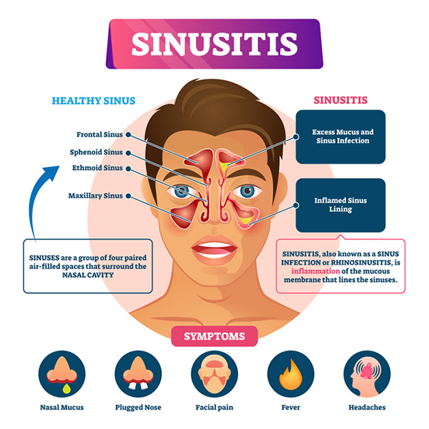 Can Sinus Pressure Cause Neck Pain All You Need To Understand