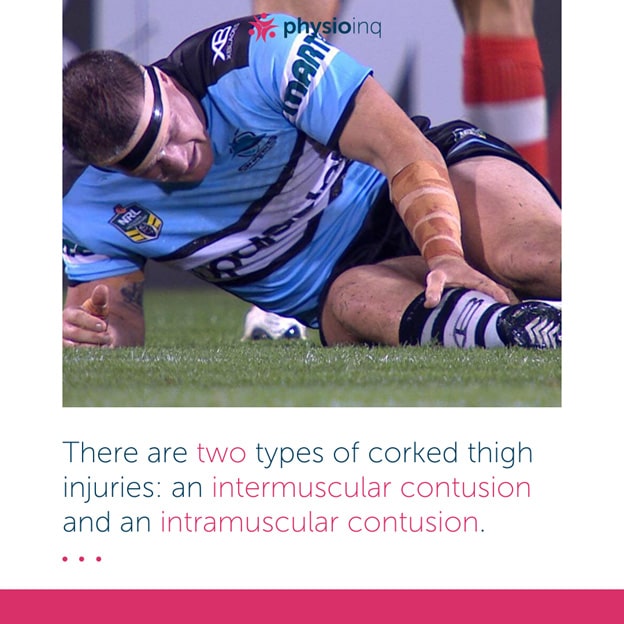 How Long Does It Take for a Corked Thigh to Heal?