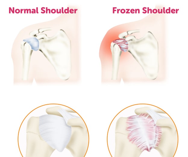 Best Massages for Treating A Frozen Shoulder