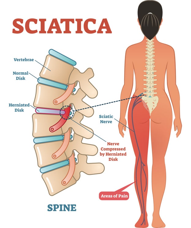 5 Yoga Poses and Exercises to Ease Sciatica Pain