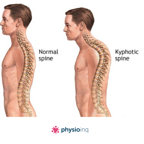 Hyperkyphosis Disease 