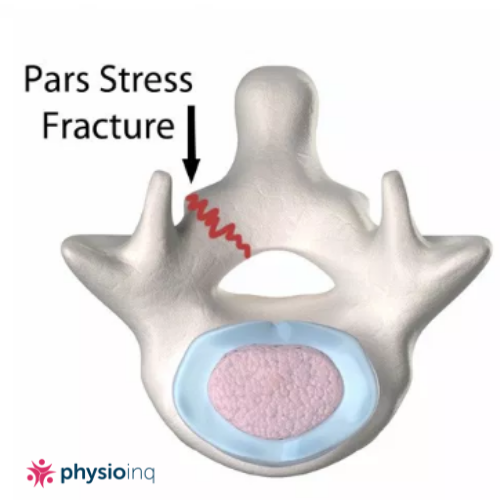 Stress Fractures Vertebrae