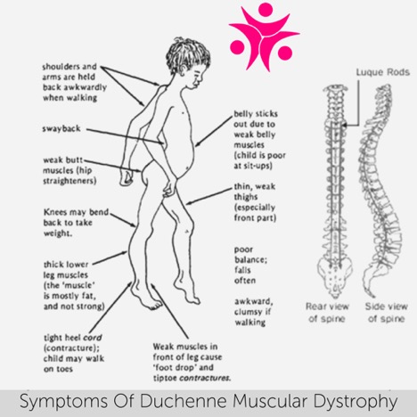 duchenne muscular dystrophy treatment